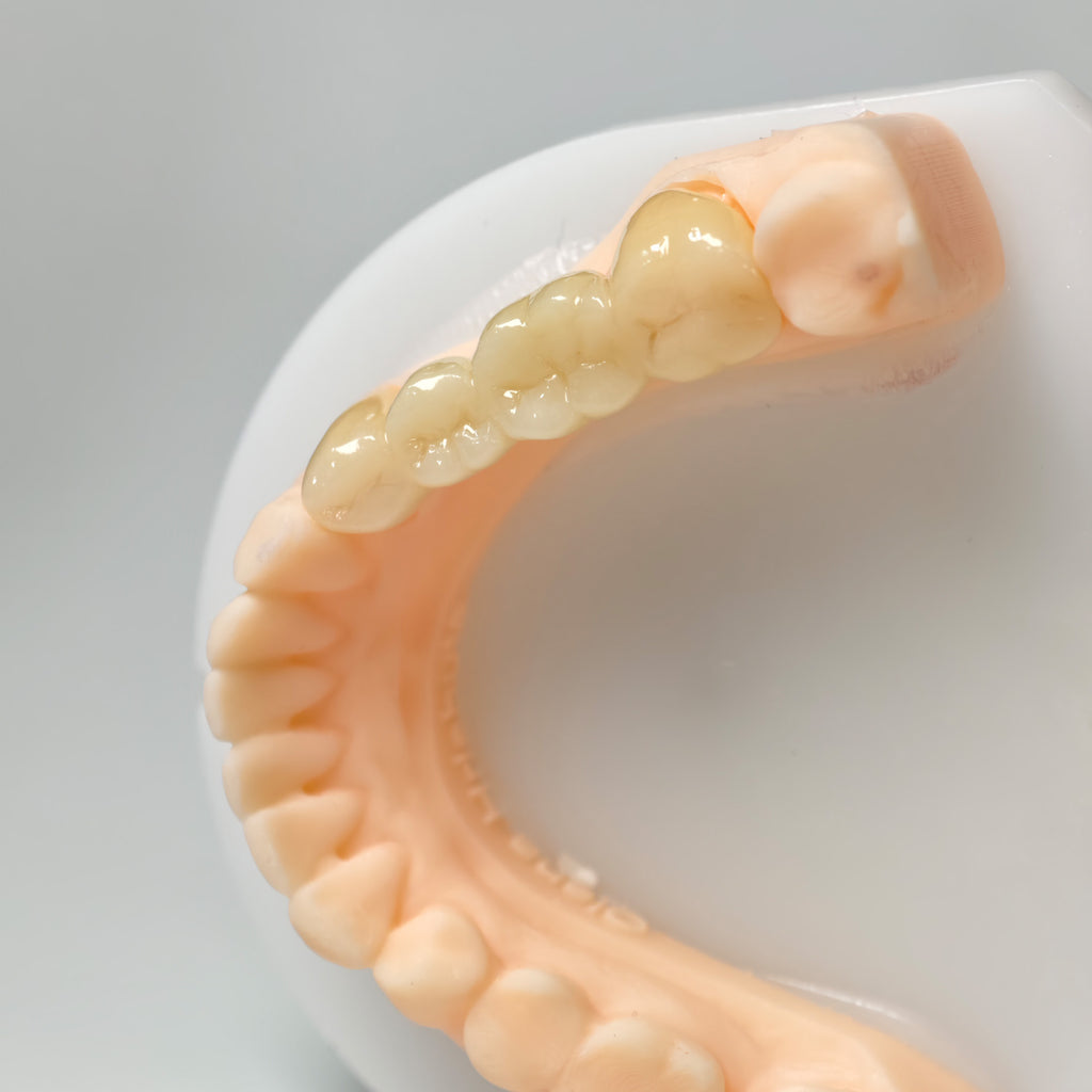 High - Strength Zirconia Bridge