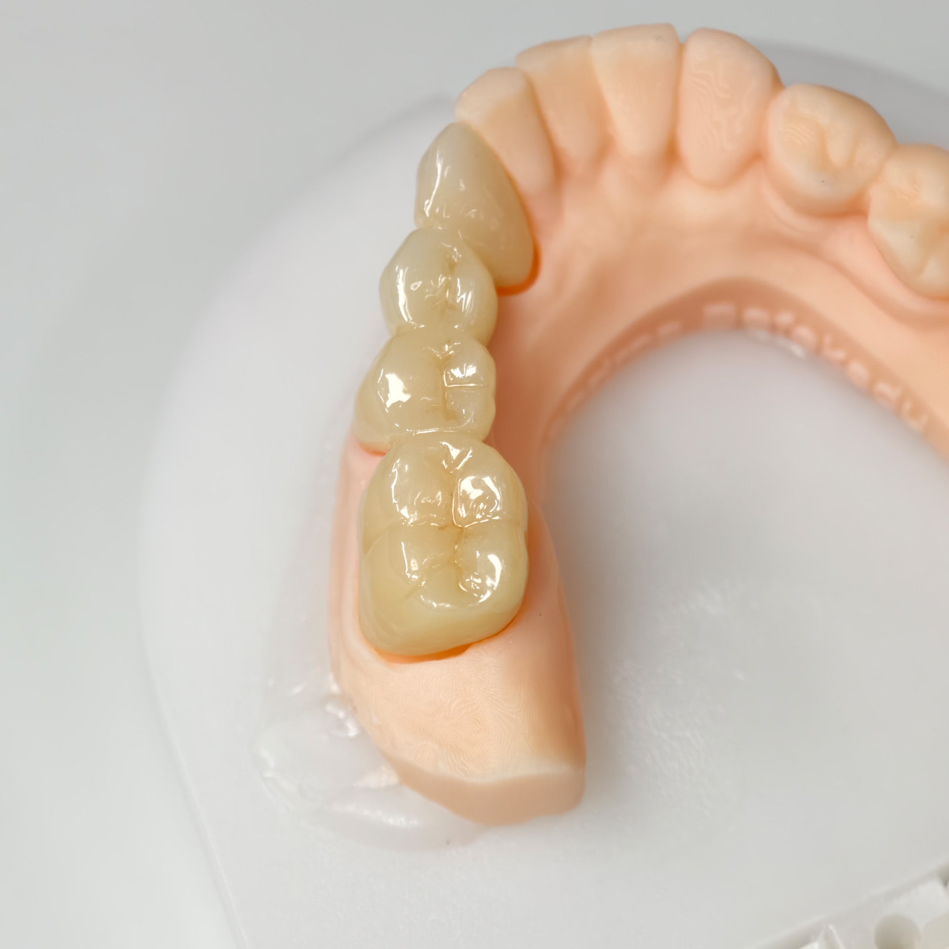 High - Strength Zirconia Bridge