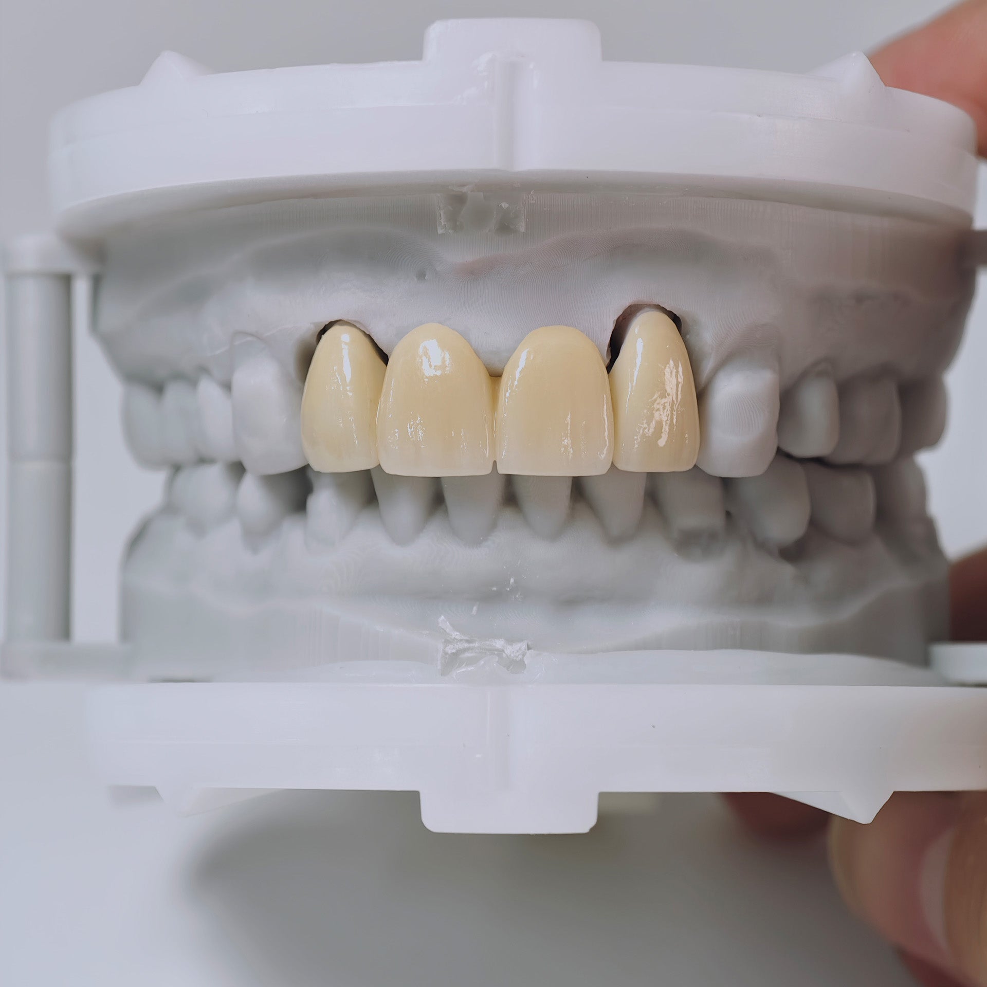 High - Strength Zirconia Bridge
