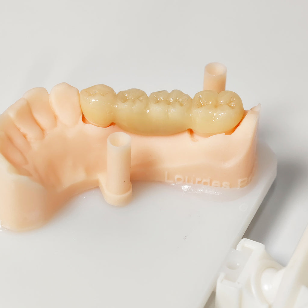 High - Strength Zirconia Bridge