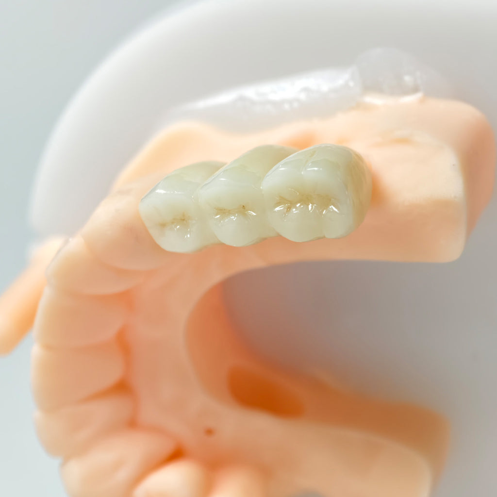 High - Strength Zirconia Bridge