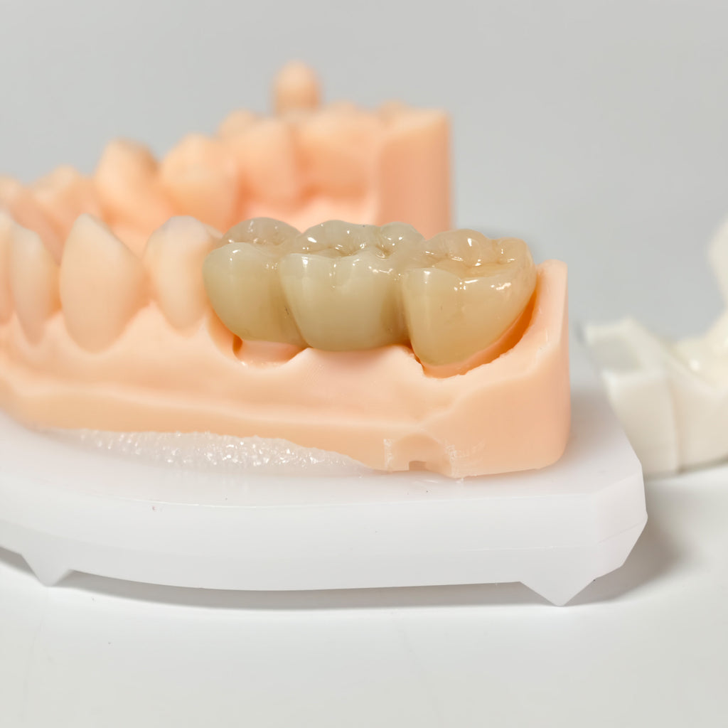 High - Strength Zirconia Bridge
