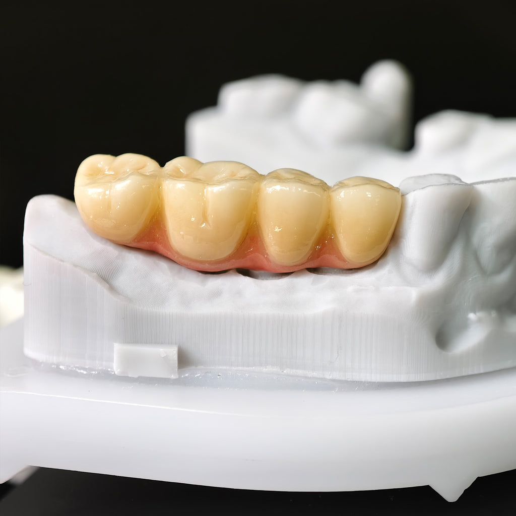 High - Strength Zirconia Bridge