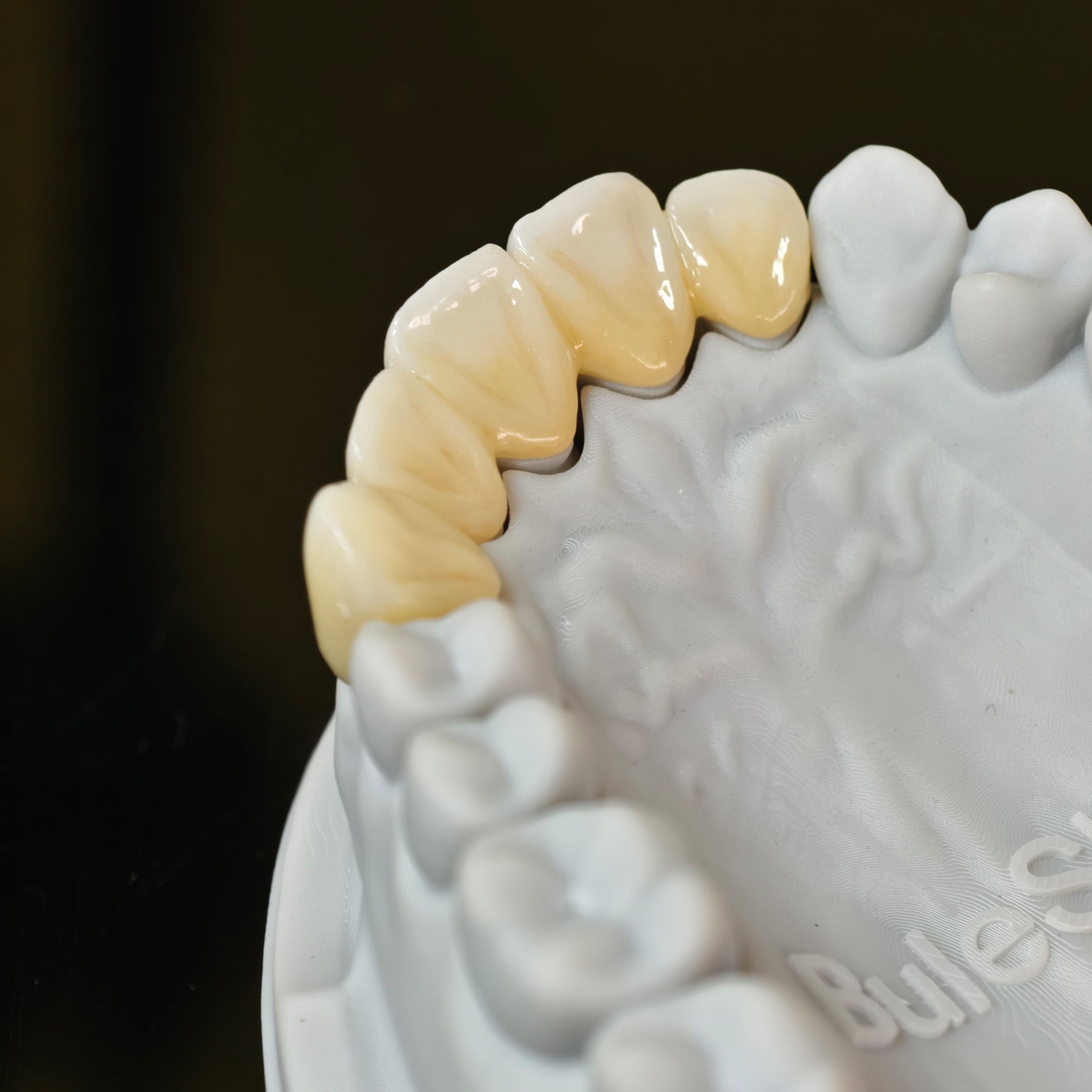 High - Strength Zirconia Bridge