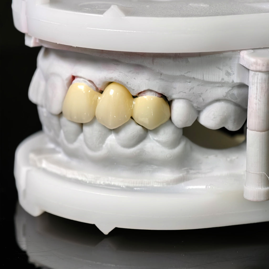 High - Strength Zirconia Bridge