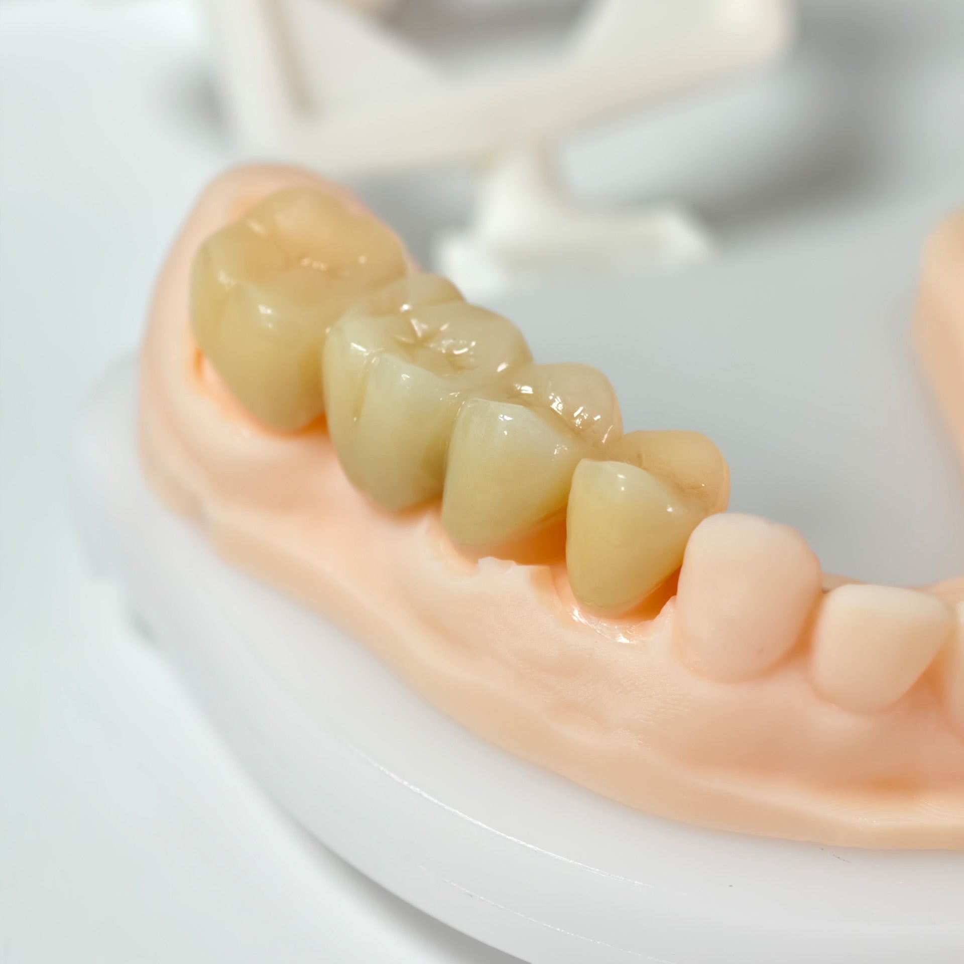 High - Strength Zirconia Bridge And Crown