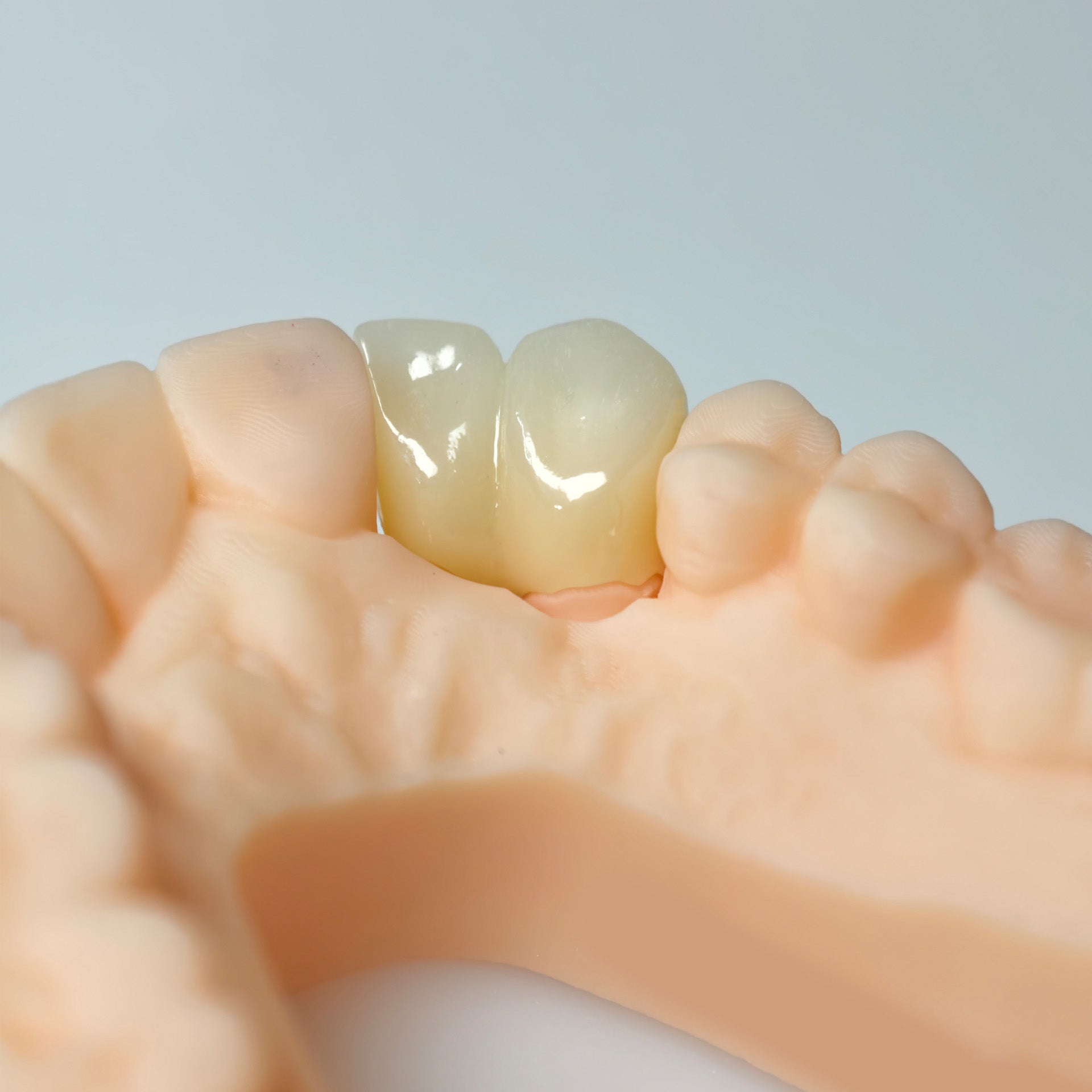 High - Strength Zirconia Crown