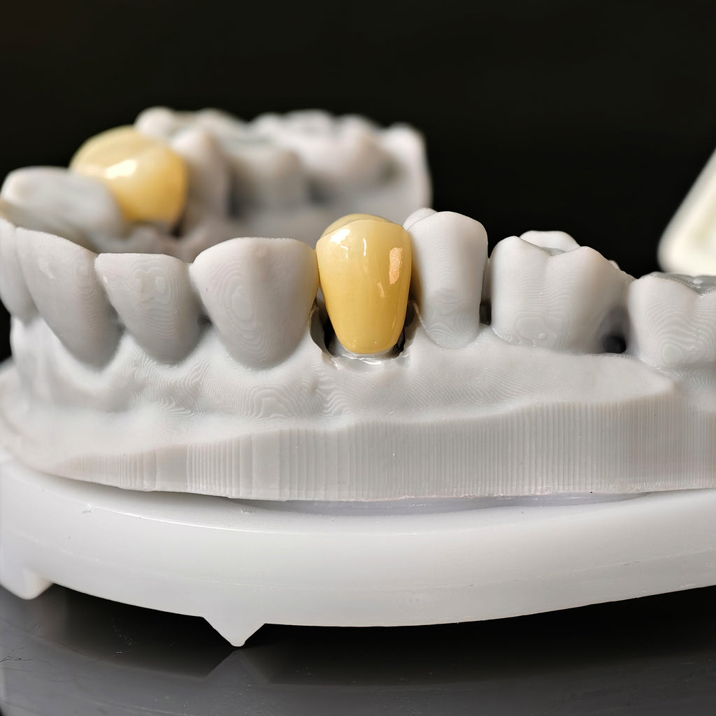 High - Strength Zirconia Crowns