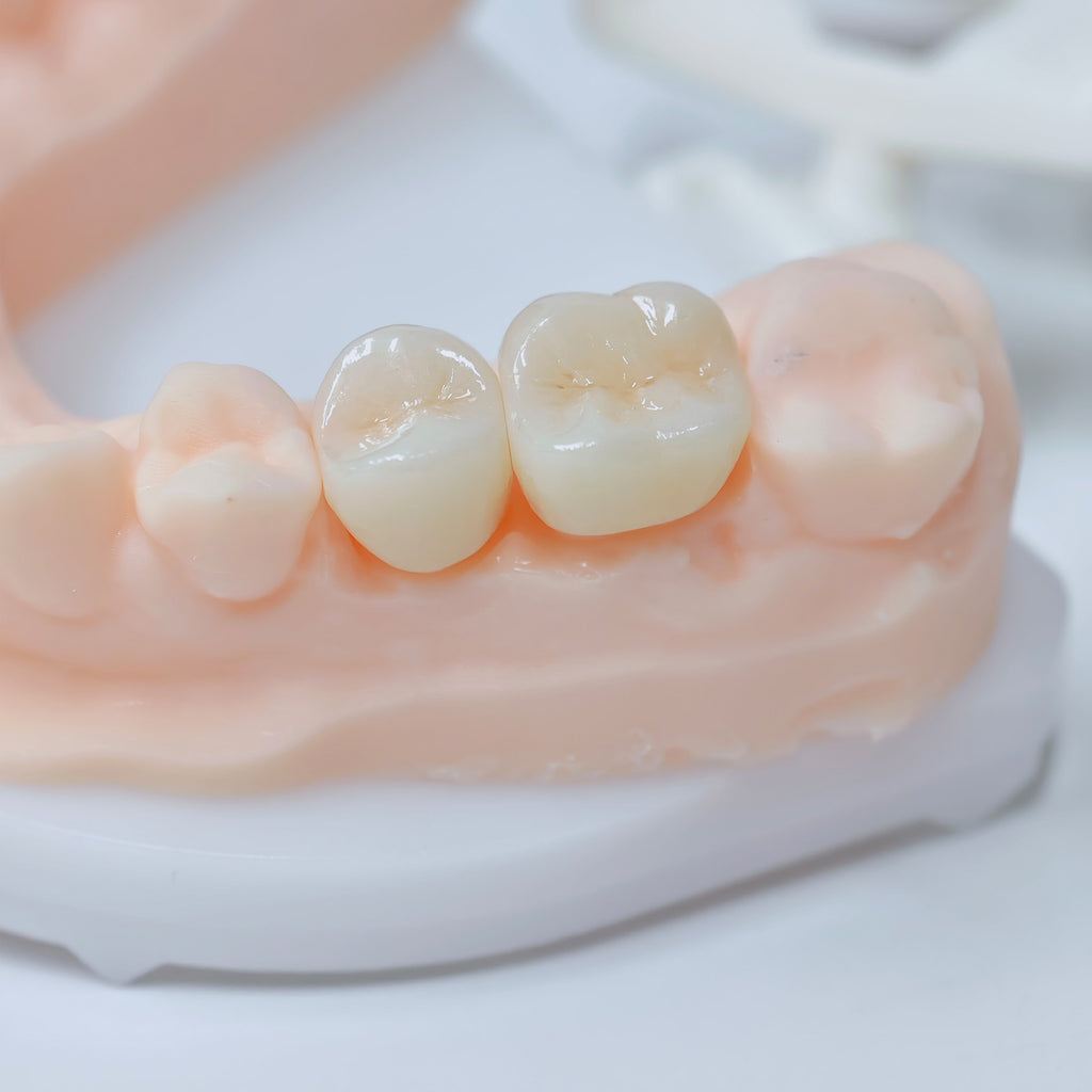 High - Strength Zirconia Crowns