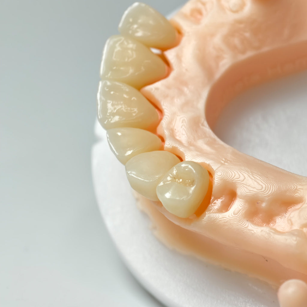 High - Strength Zirconia Crowns