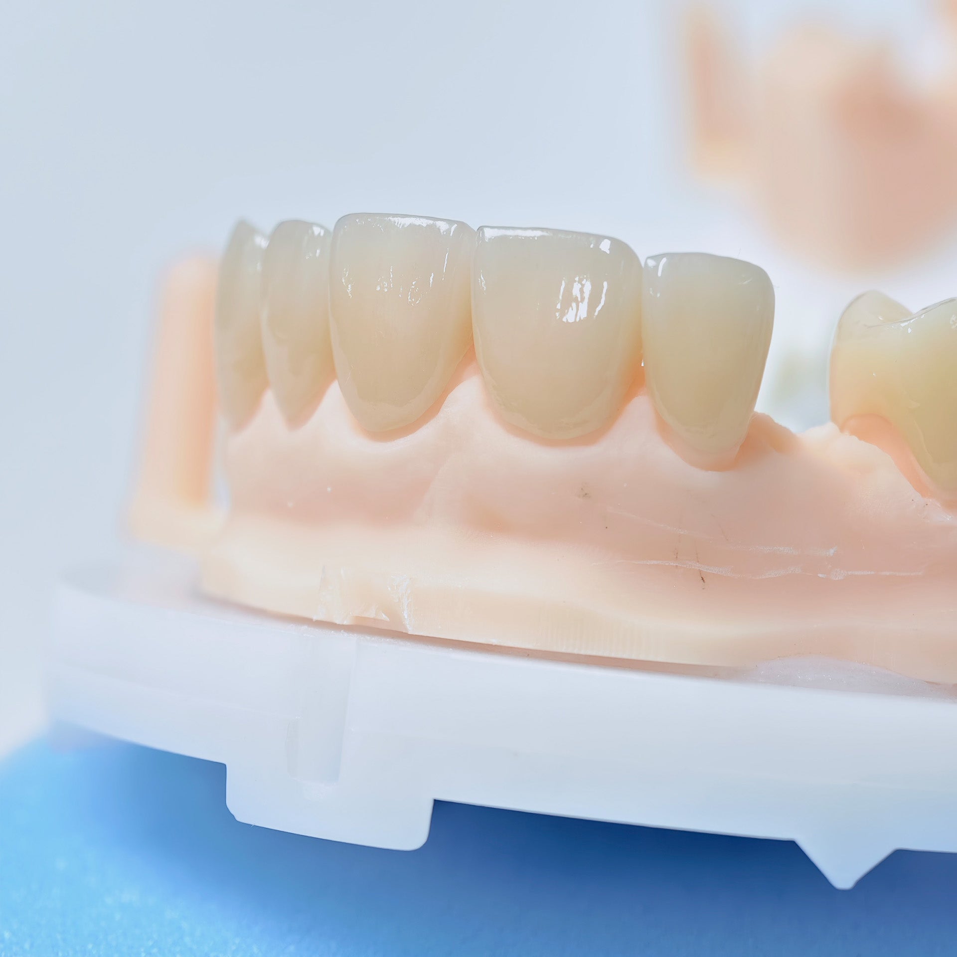 High - Strength Zirconia Crowns And Ceramic Veneers
