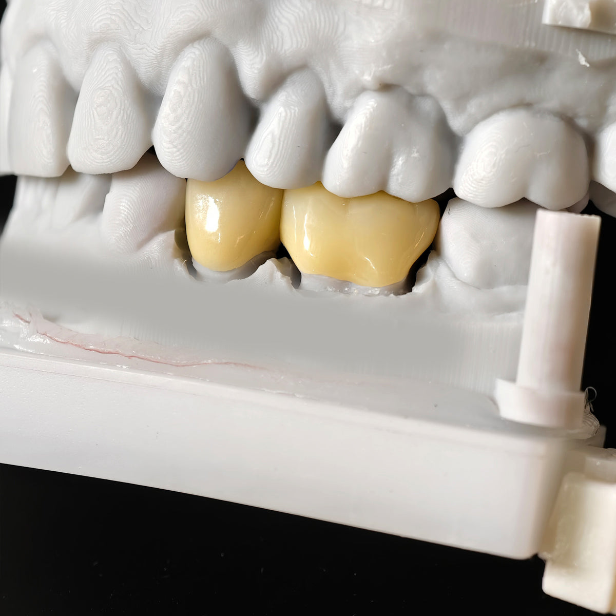 High - Strength Zirconia Dental Crowns