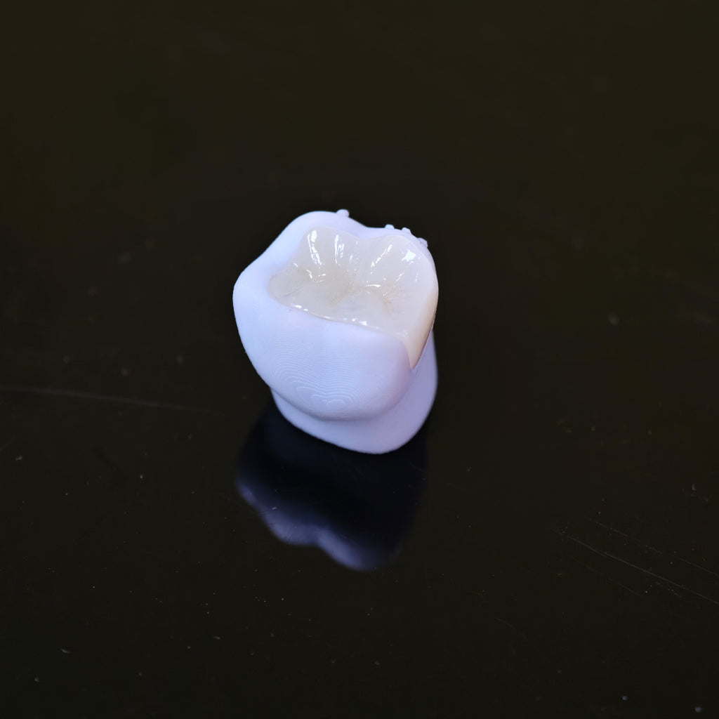 High - Strength Zirconia Inlay And Crown