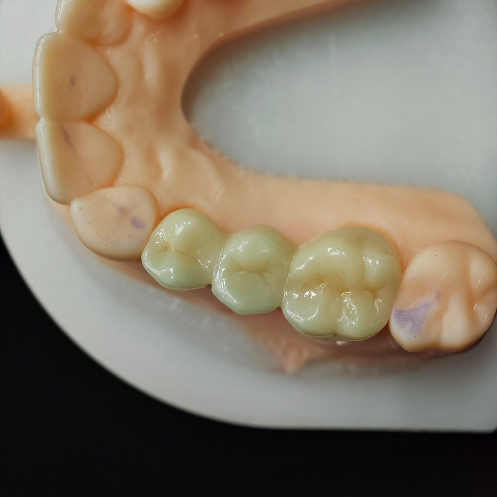 High - Strength Zirconia Bridge
