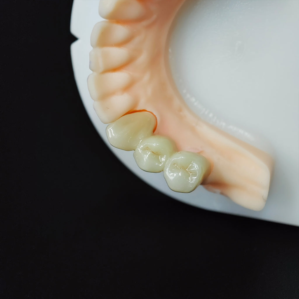 High - Strength Zirconia Bridge