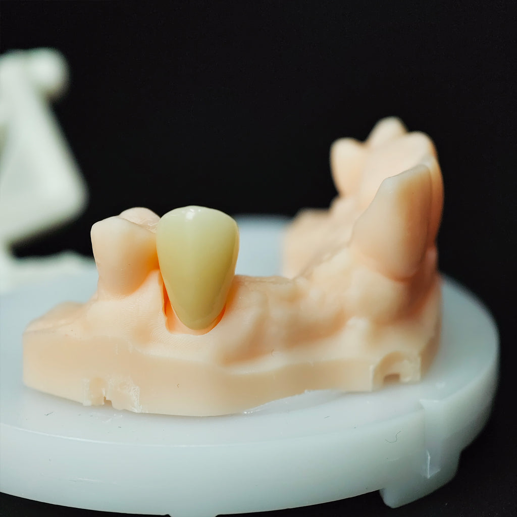 High - Strength Zirconia Crown