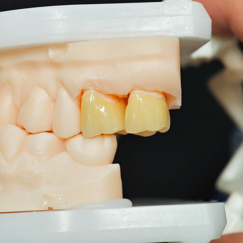 High - Strength Zirconia Crowns