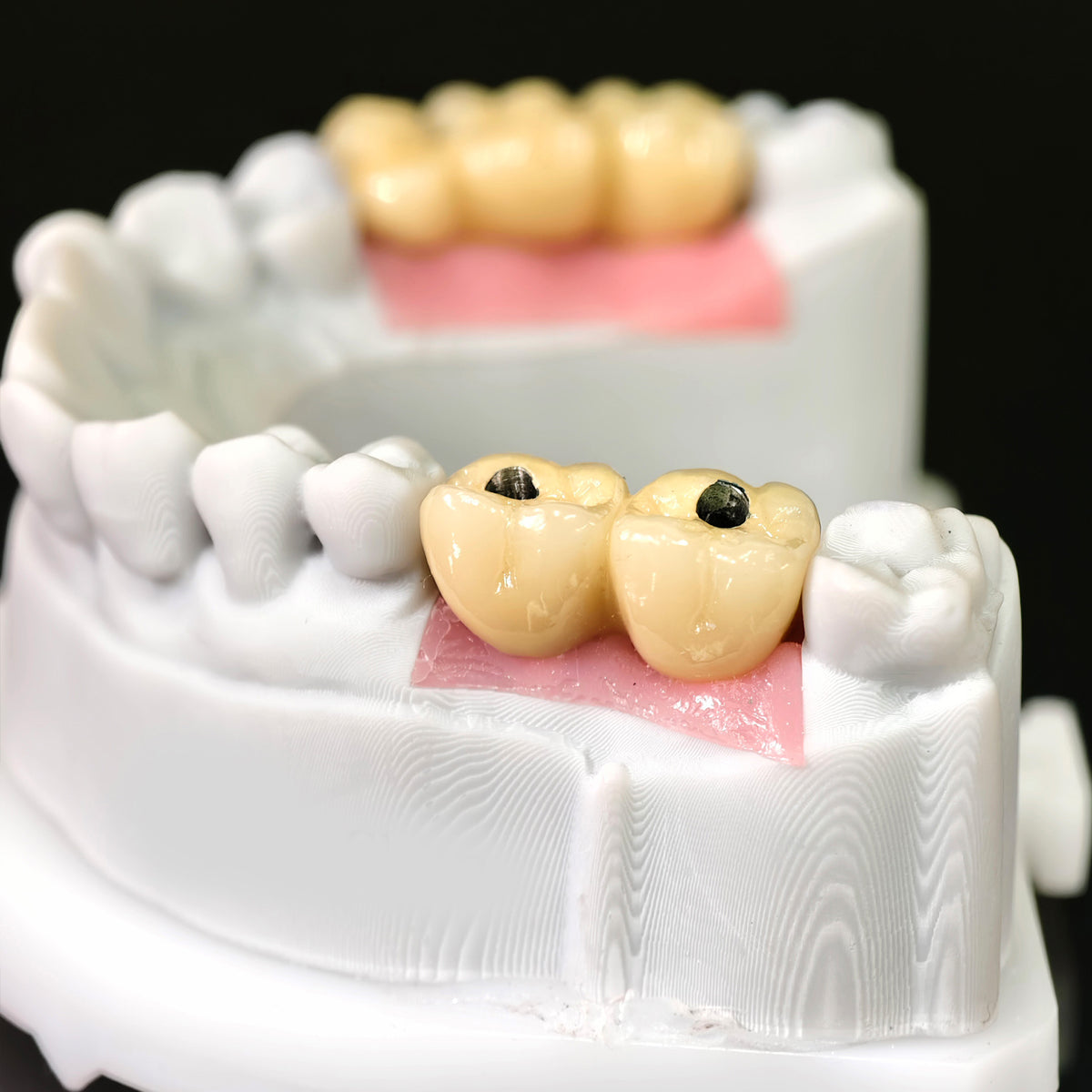 Implant-supported Co - Cr PFM Dental Bridge