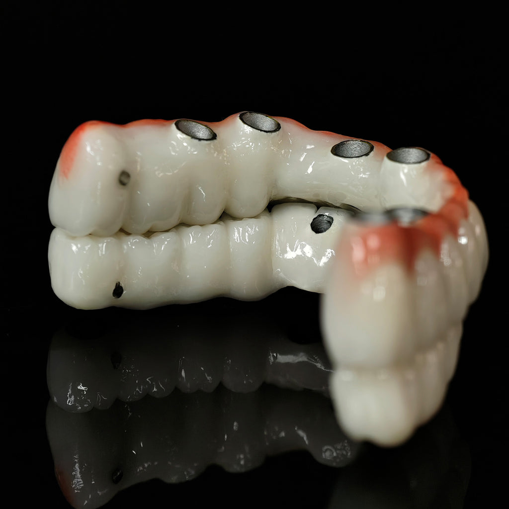 Implant-supported Co - Cr PFM Dental Bridge
