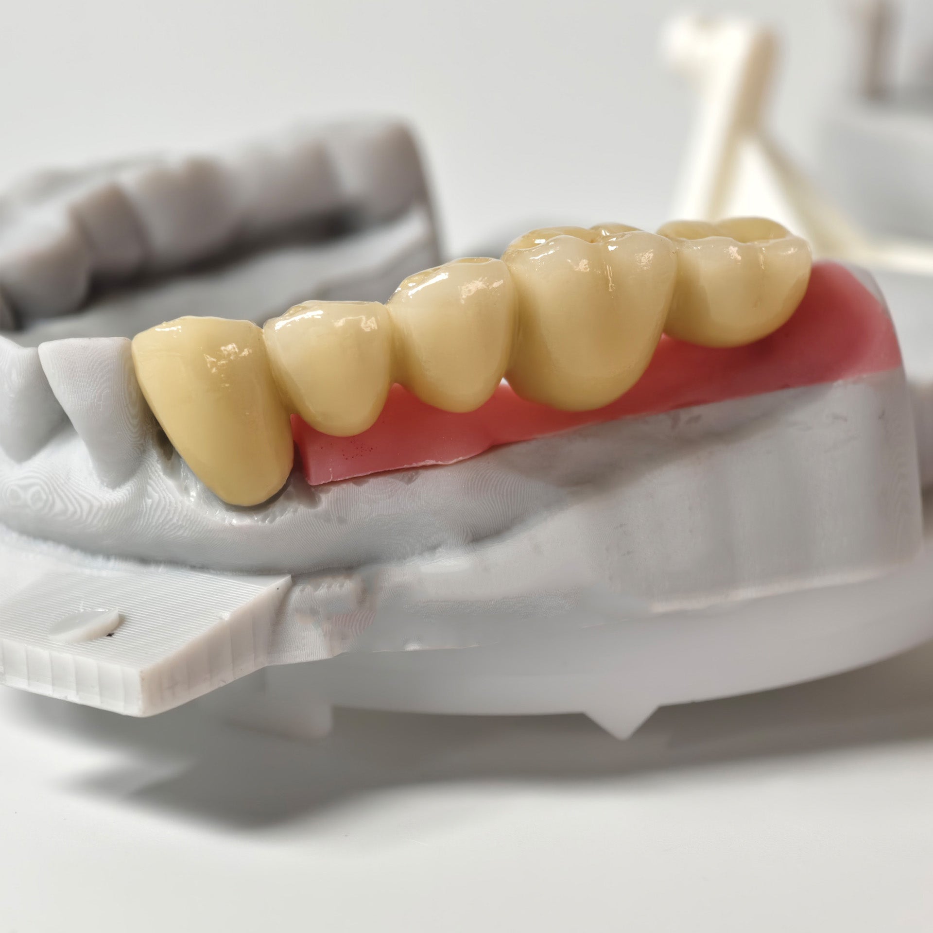 Implant-Supported PFM Single Bridge