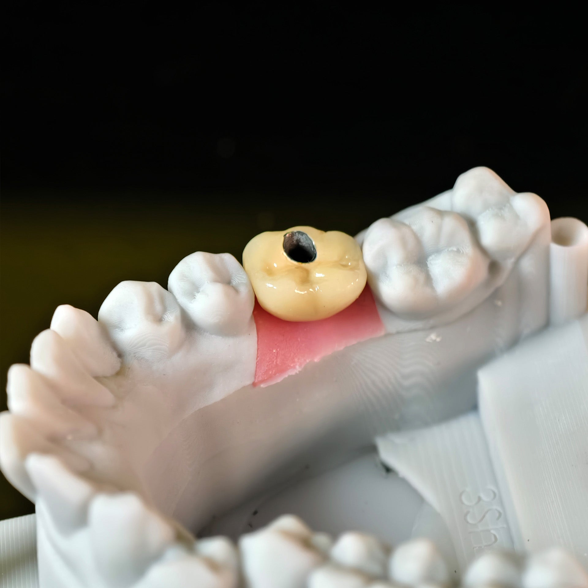 Implant-Supported PFM Single Crown
