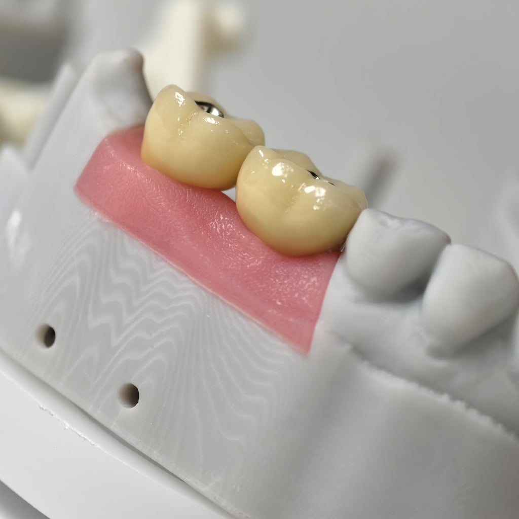 Implant-Supported PFM Single Crowns