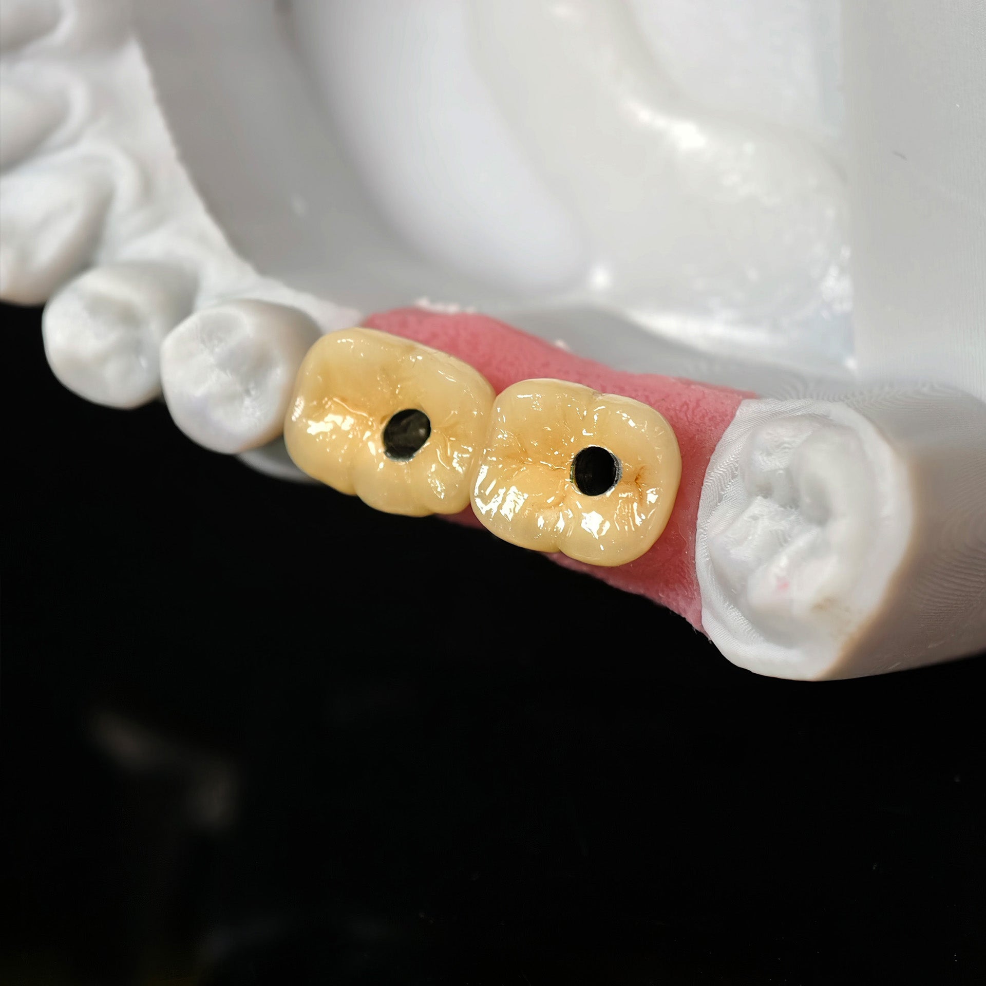 Implant-Supported PFM Single Crowns