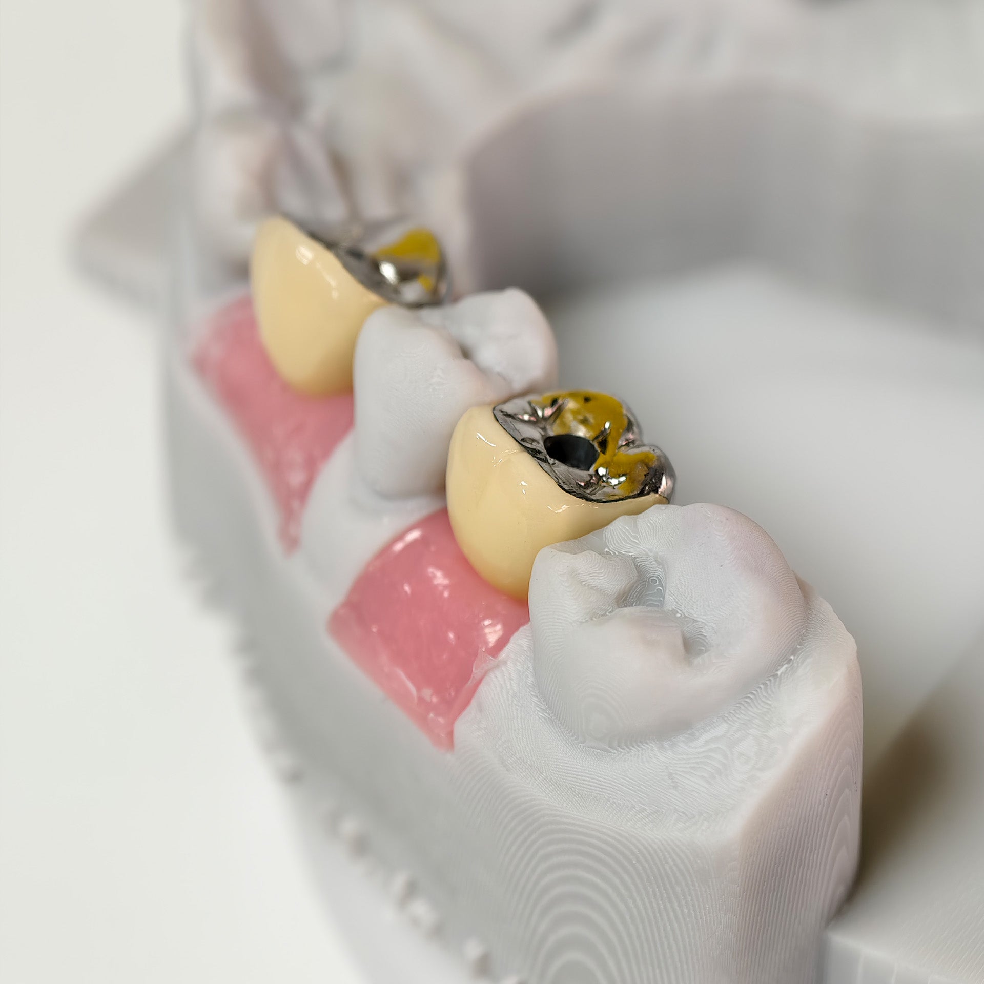 Implant-Supported PFM Single Crowns With Metal