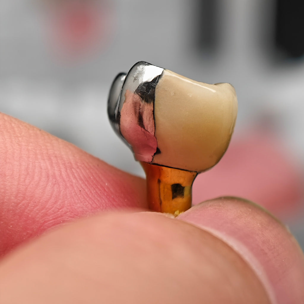 Implant-Supported PFM Single Crown With Metal