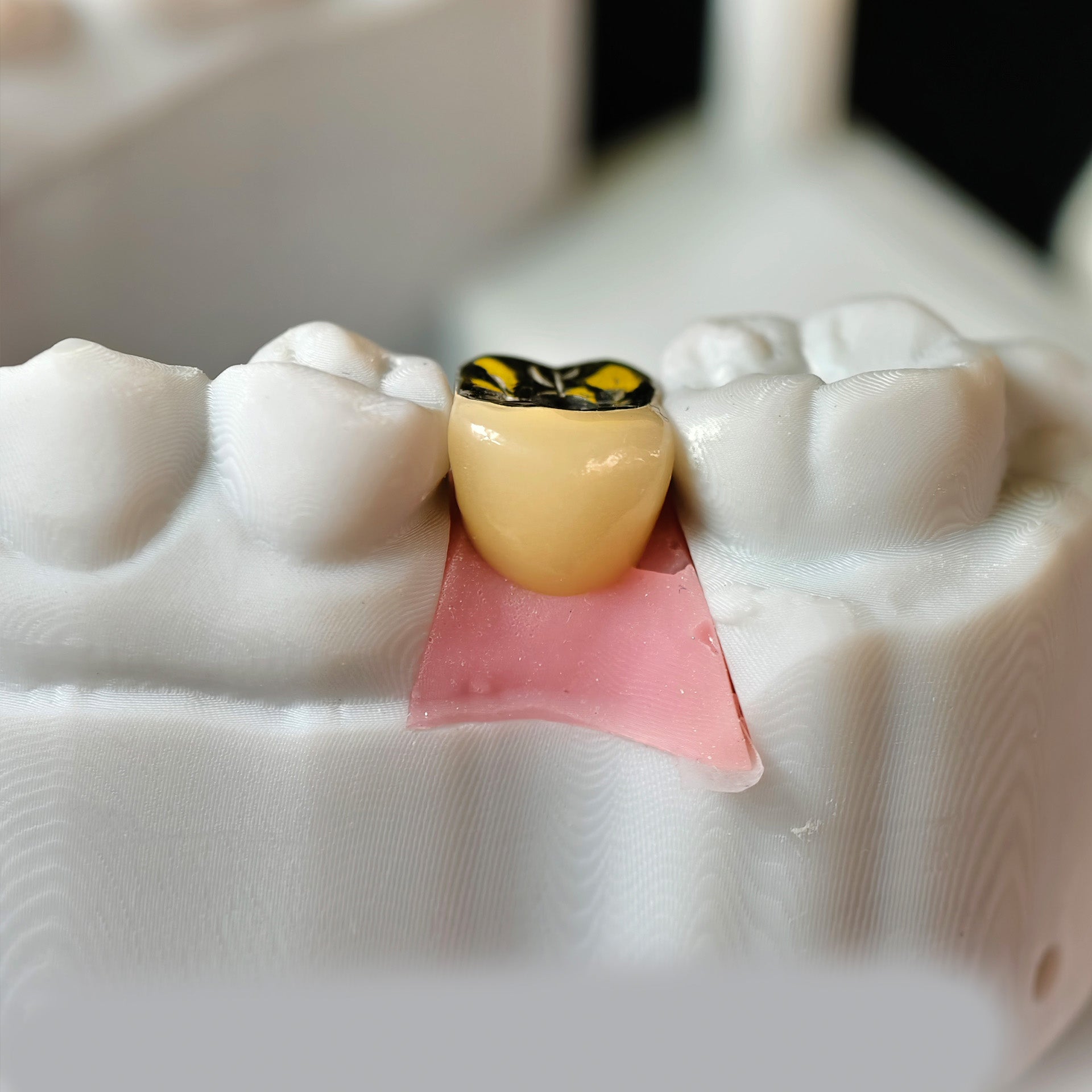 Implant-Supported PFM Single Crown With Metal