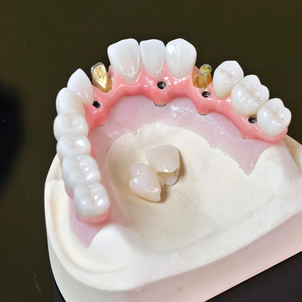 Malo Bridge With Gold-Plated Grade 5 Pure Titanium Malo Bridge