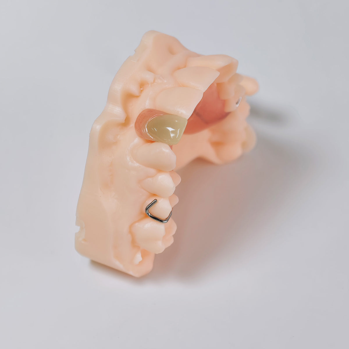 Metal Clasp Partial Denture