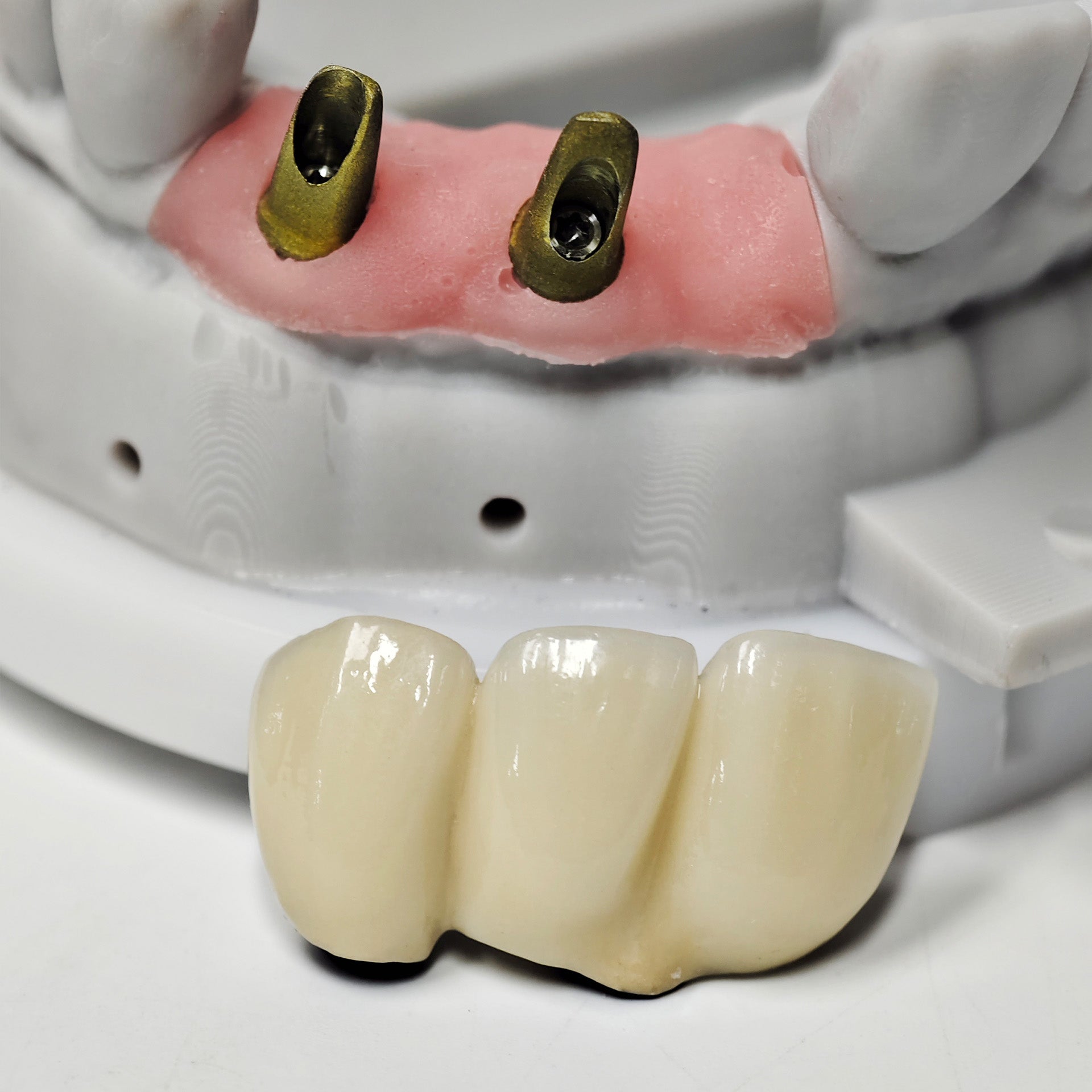 PFM Bridge With Screw-Retained And Implant Seating Guide