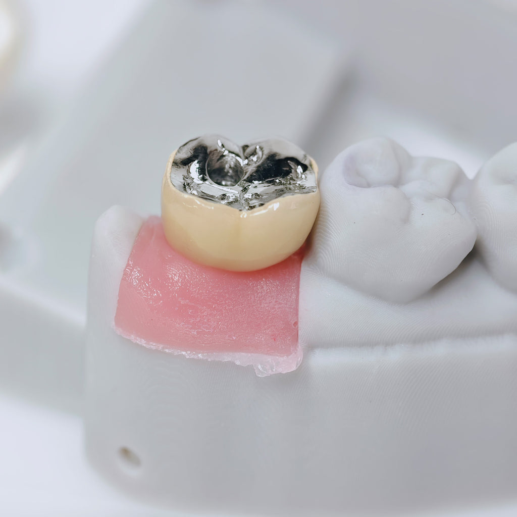 PFM Crown With Screw Retained