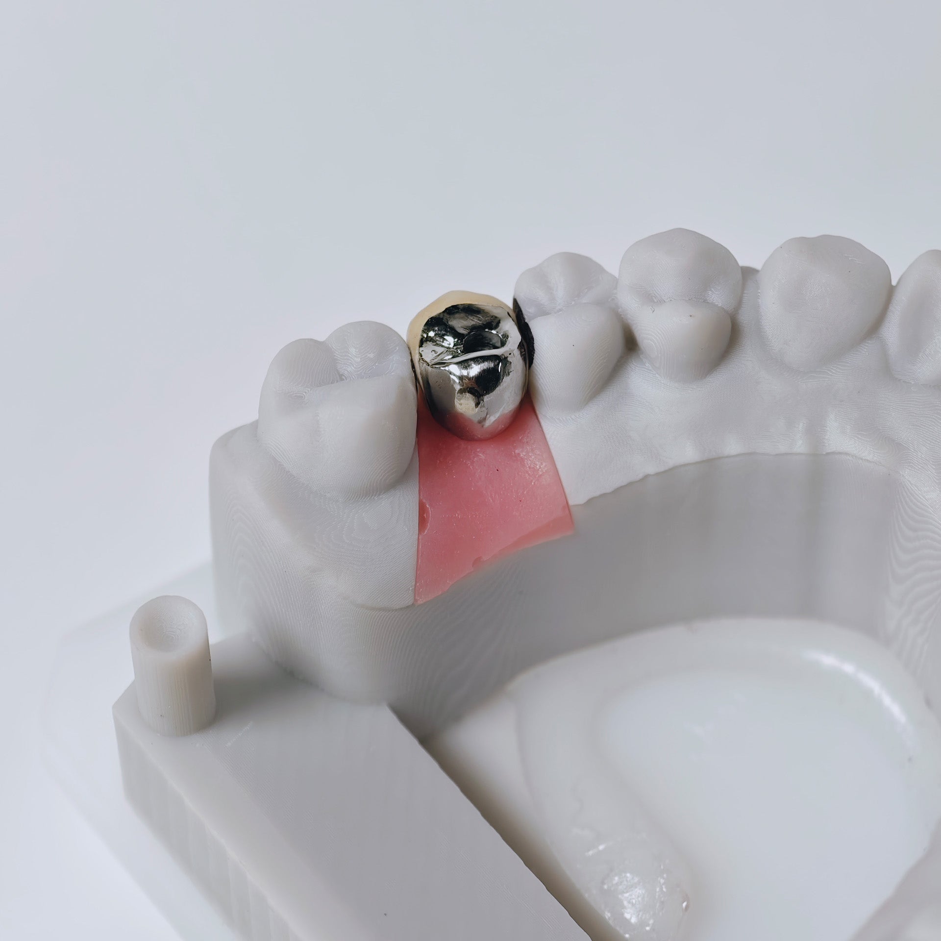 PFM Crown With Screw Retained