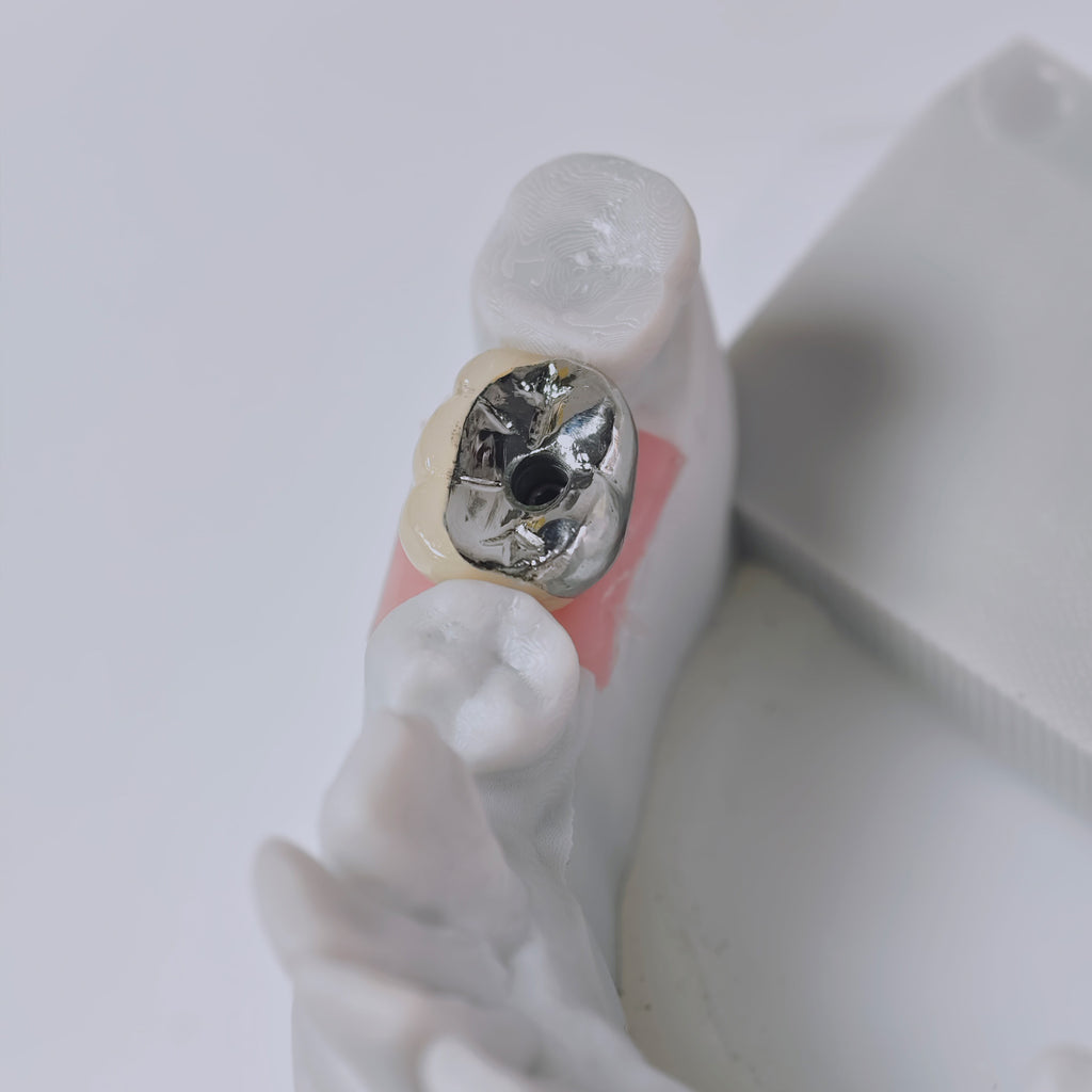 PFM Crown With Screw Retained