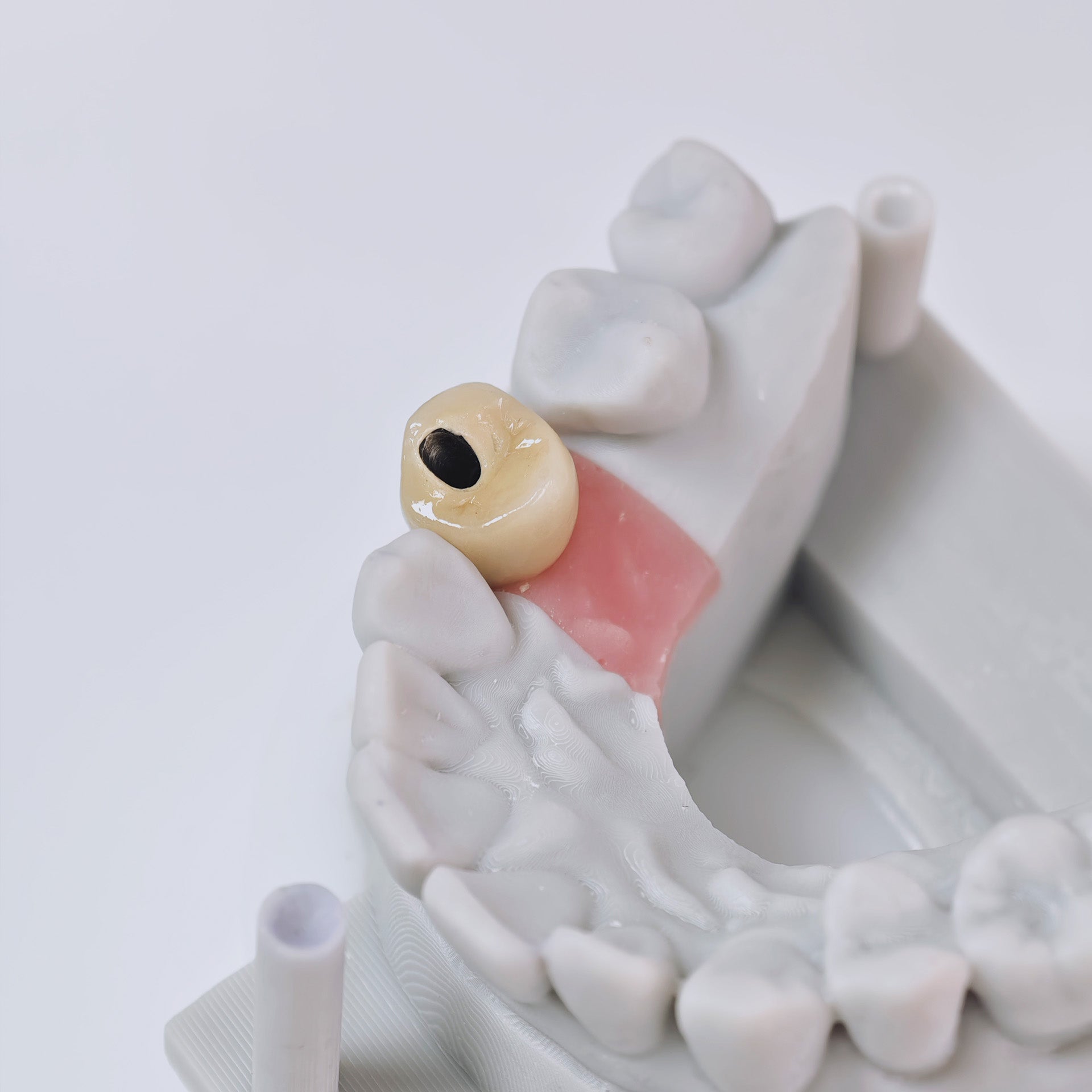PFM Crown With Screw Retained