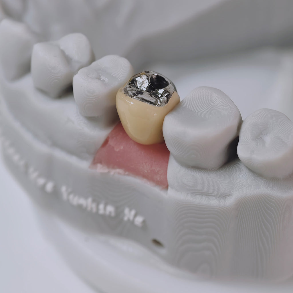 PFM Crown With Screw Retained