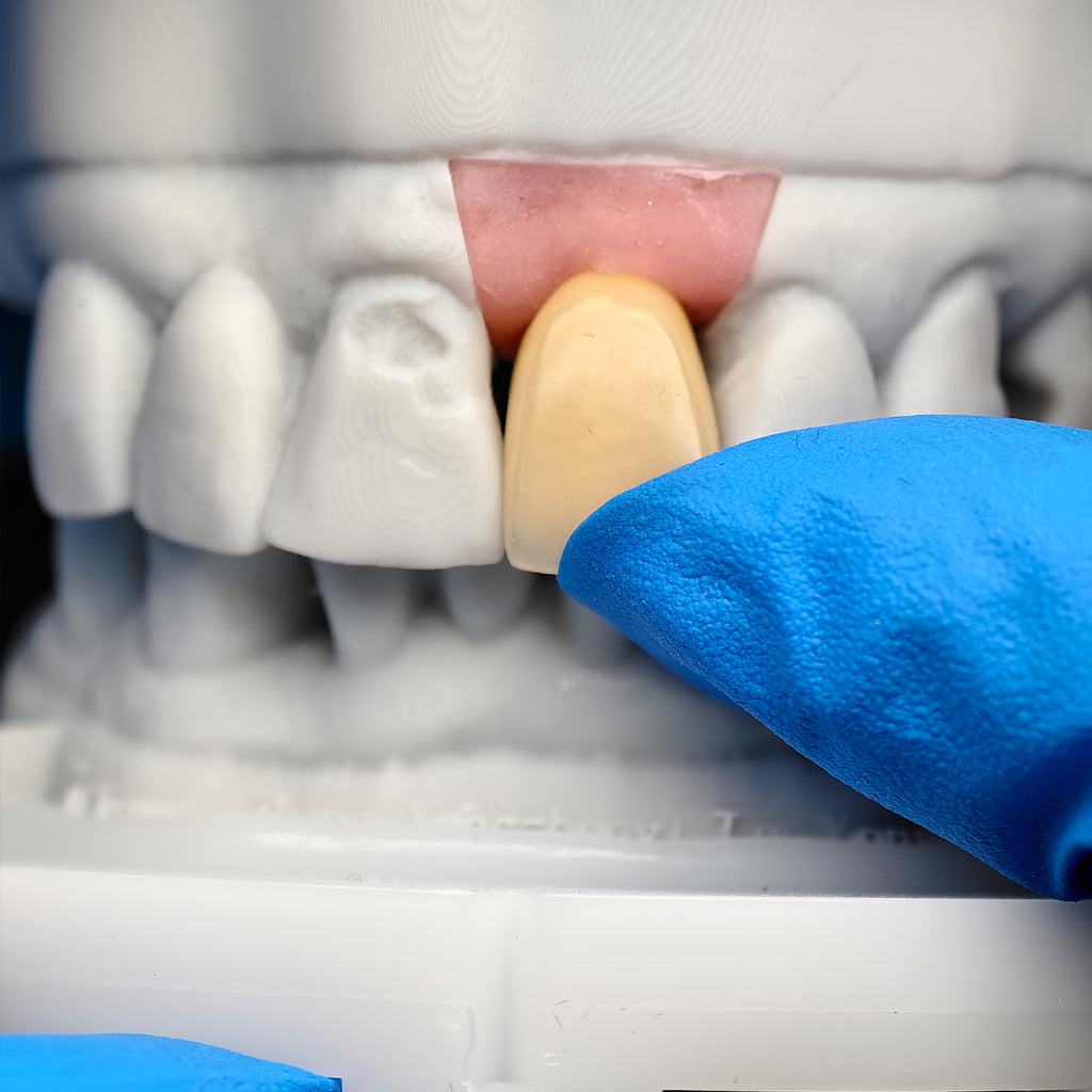 PFM Implant Crown With Cement Retained