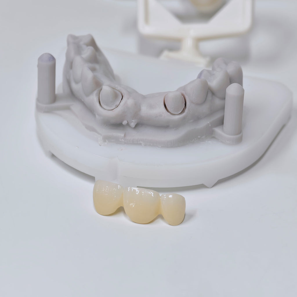 PFZ Dental Bridge – Depth And Aesthetics