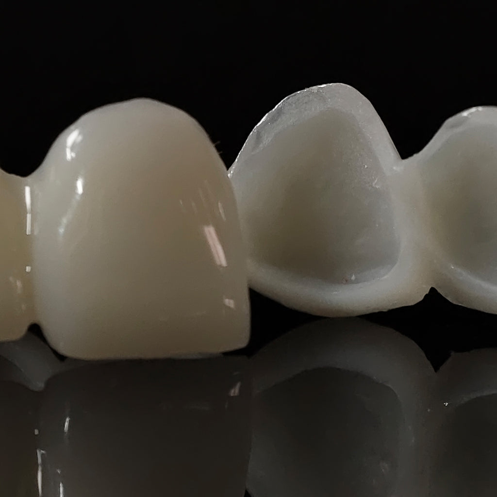 PMMA Bridge Veneer With Cement Retained