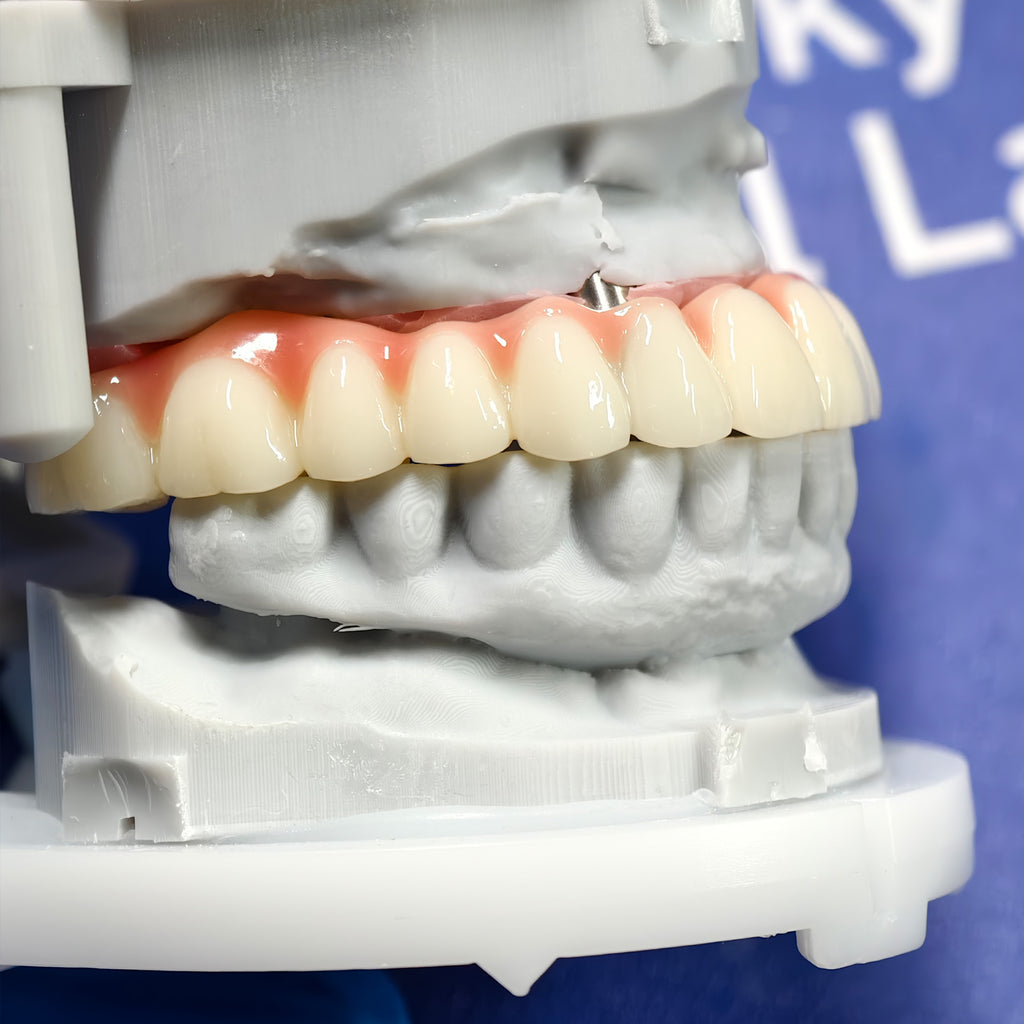 PMMA Bridge With Ti-Base Screw Retained Trying For Full Arch Restoration
