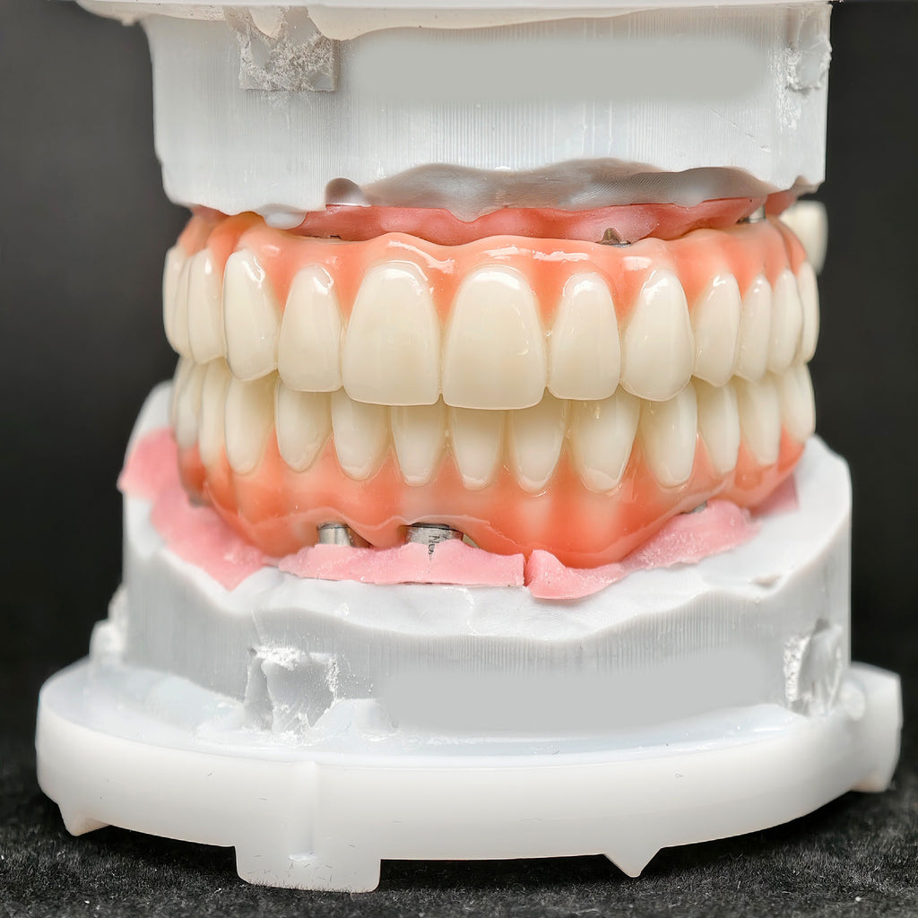 PMMA Bridge With Ti-Base Screw Retained Trying For Full Arch Restoration