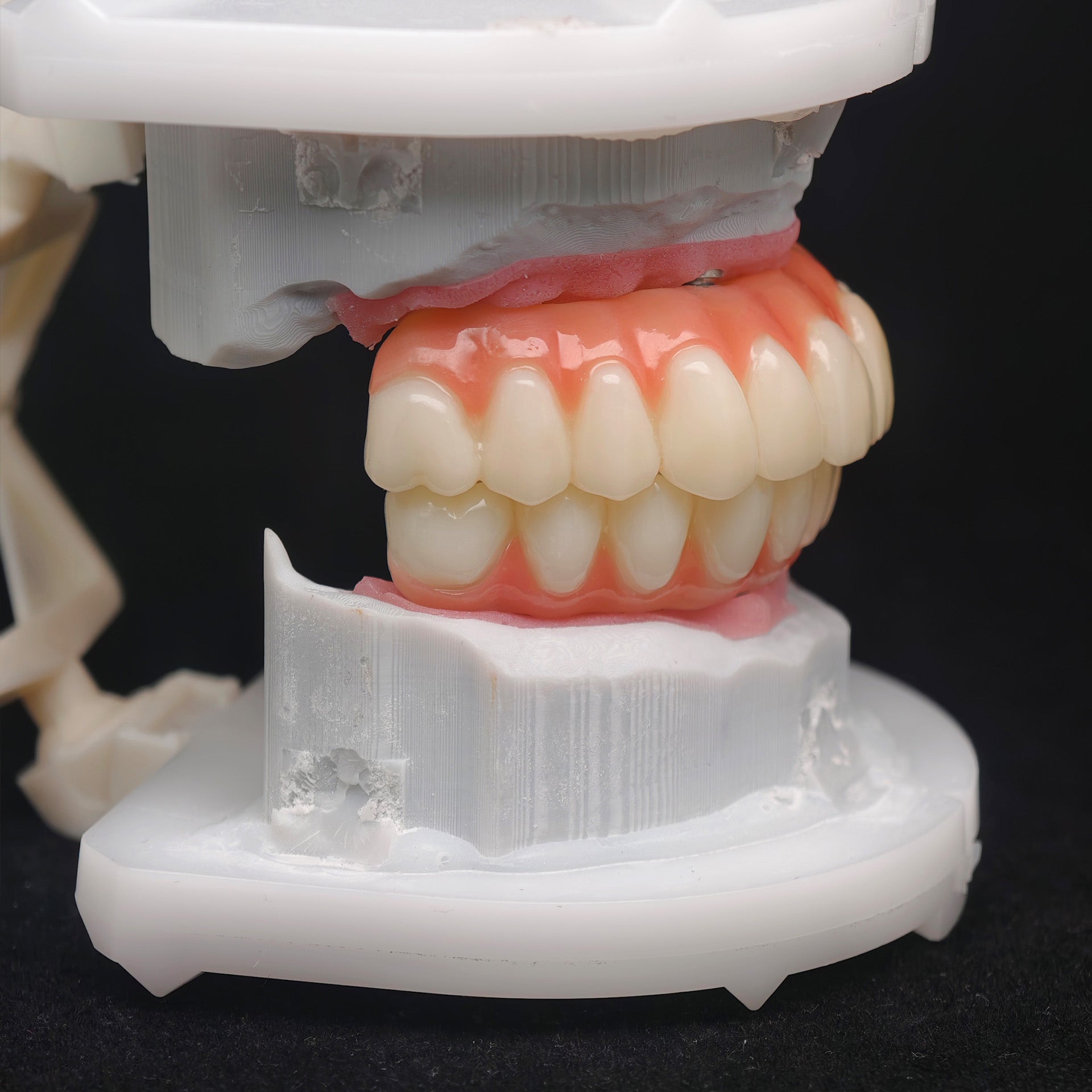PMMA Bridge With Ti-Base Screw Retained Trying For Full Arch Restoration