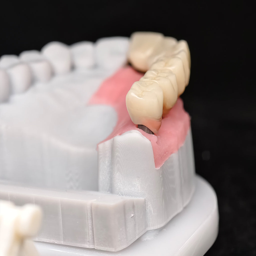 PMMA Bridge With Custom Abutment And Implant Seating Guide