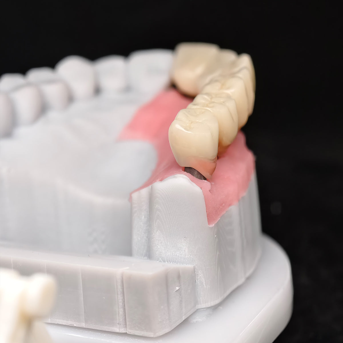 PMMA Bridge With Custom Abutment And Implant Seating Guide