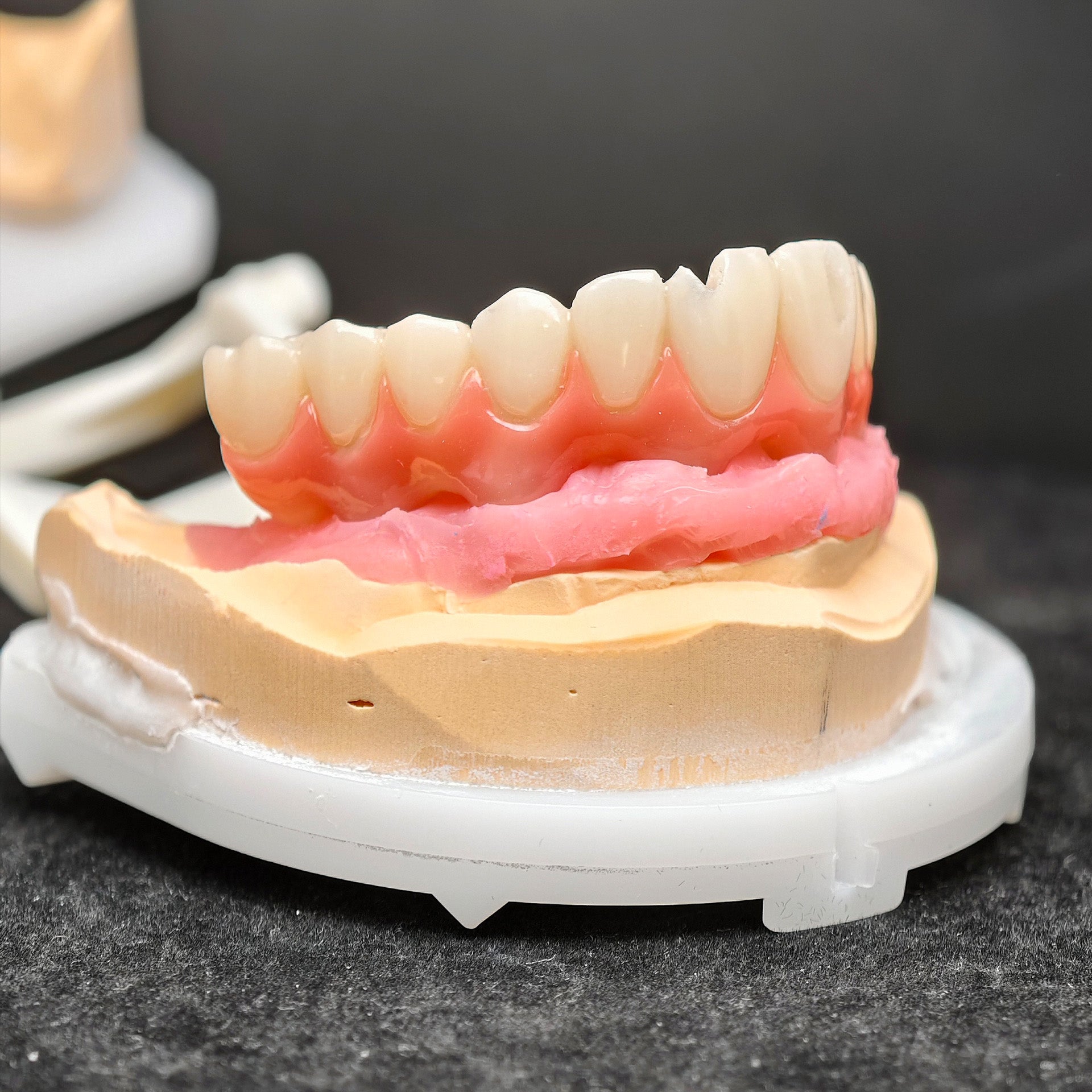 Pmma Bridge With Screw-Retained