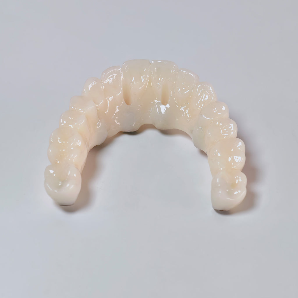 PMMA Bridge With Screw Retained