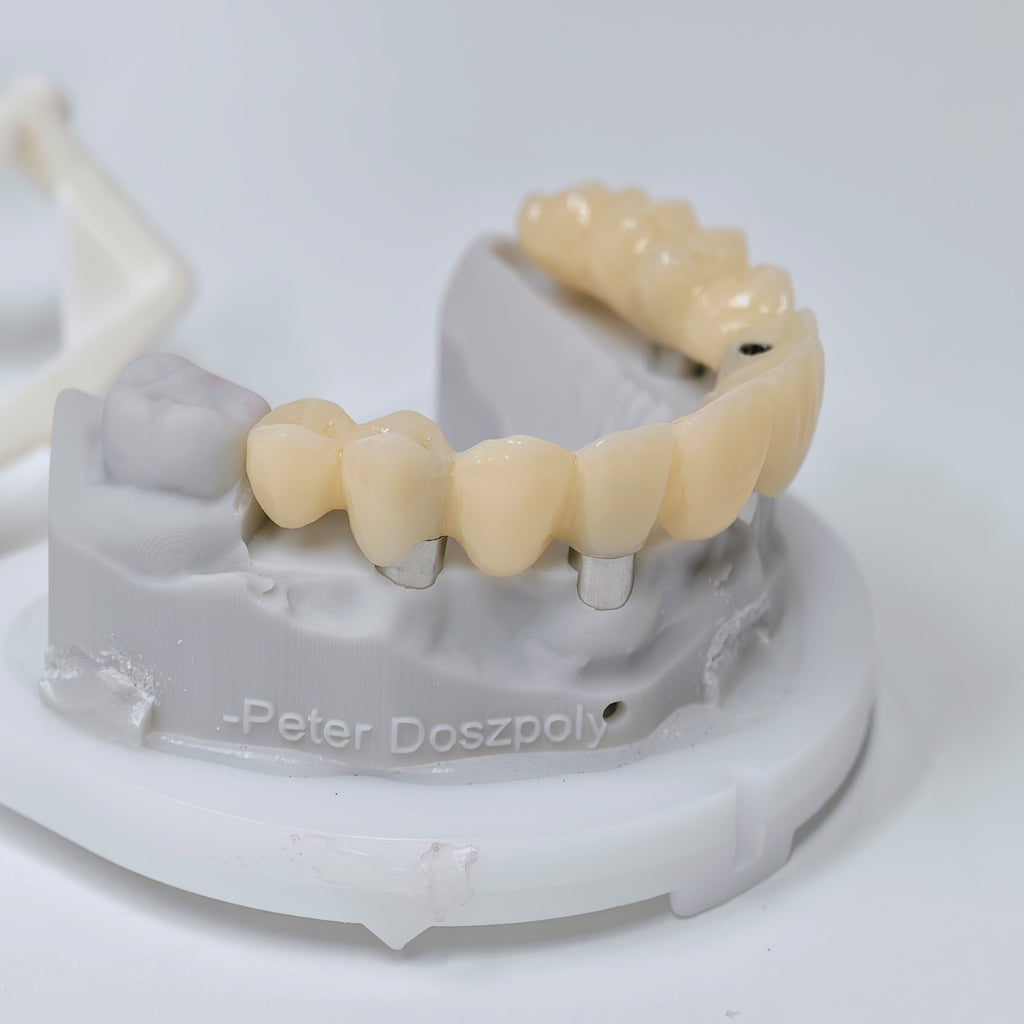 PMMA Bridge With Screw Retained