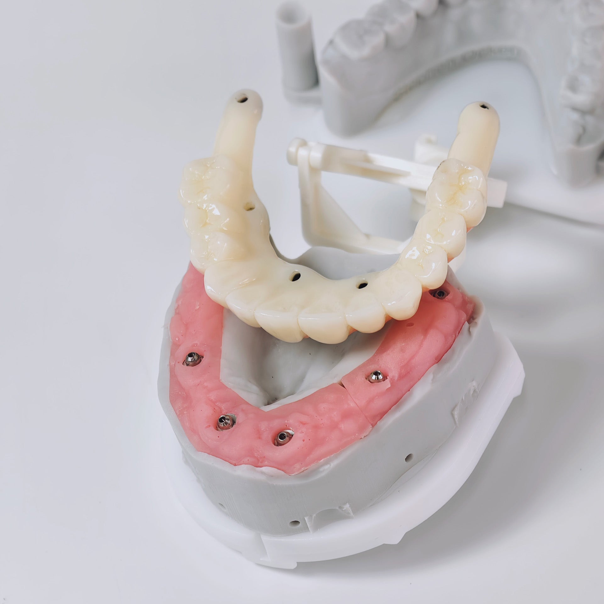 PMMA Bridge With Screw Retained